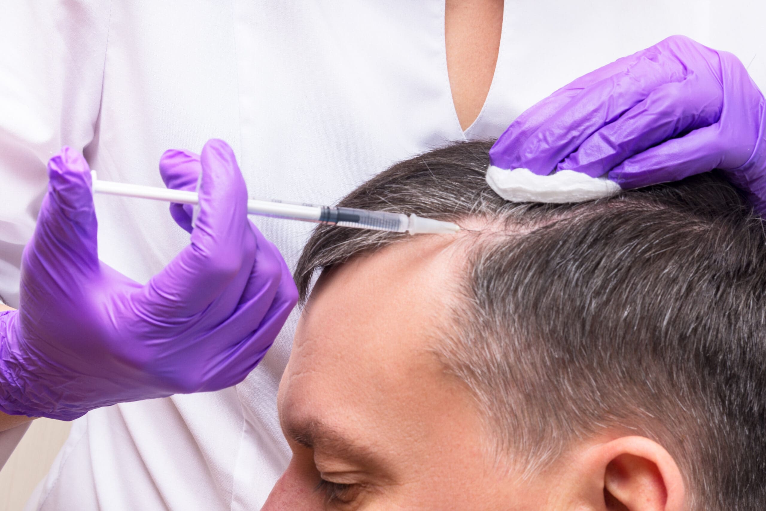 Injection Treatment For Hair Loss