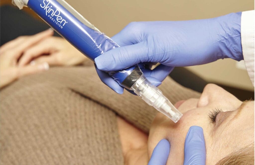 Advanced Microneedling with Exosomes - Dyana Raskin Aesthetics